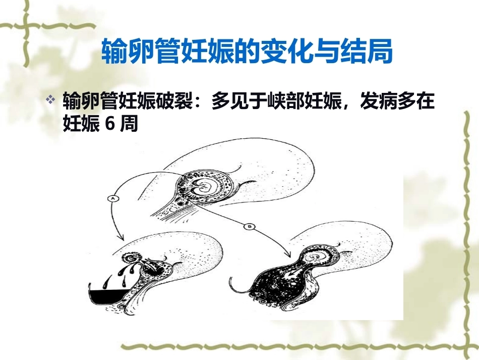 输卵管妊娠中以壶腹部妊娠最多_第12页