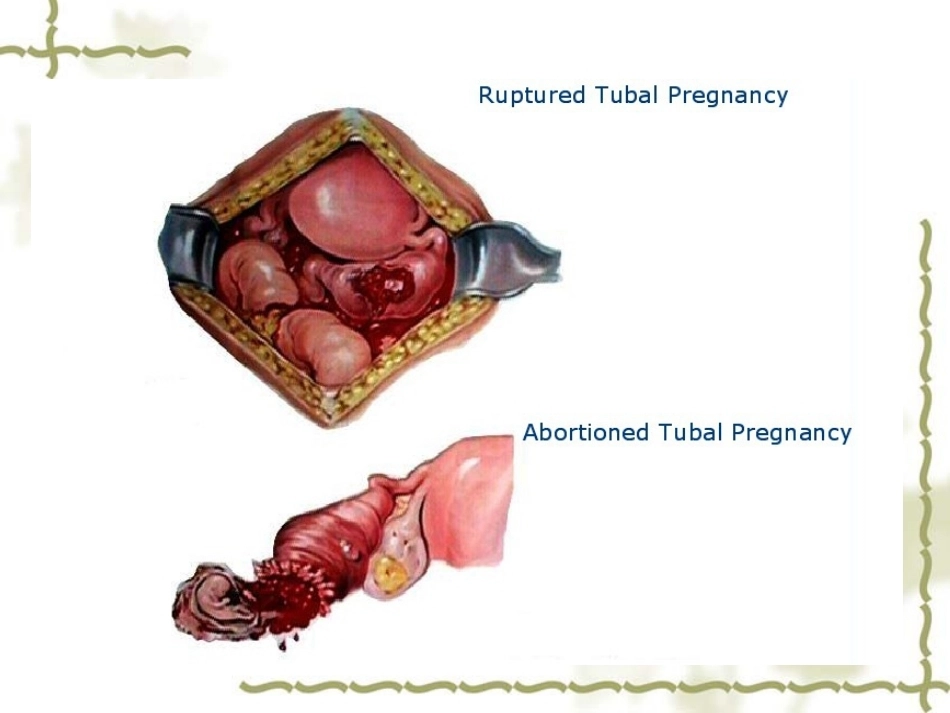 输卵管妊娠中以壶腹部妊娠最多_第13页