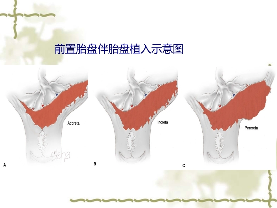 妊娠晚期出血(产前出血)_第9页