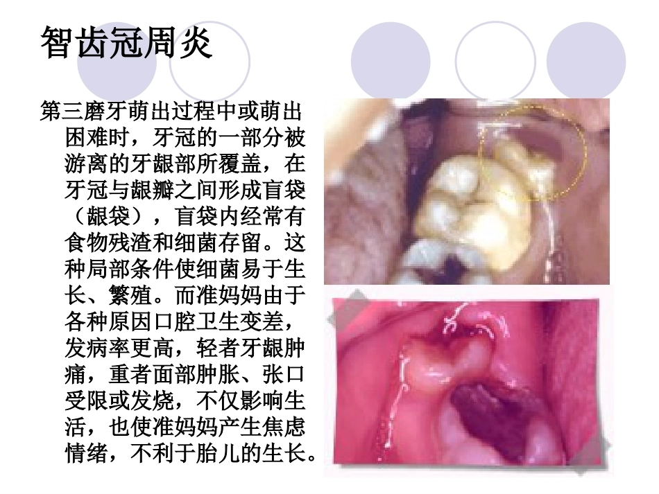 妊娠期口腔保健知识普及_第9页