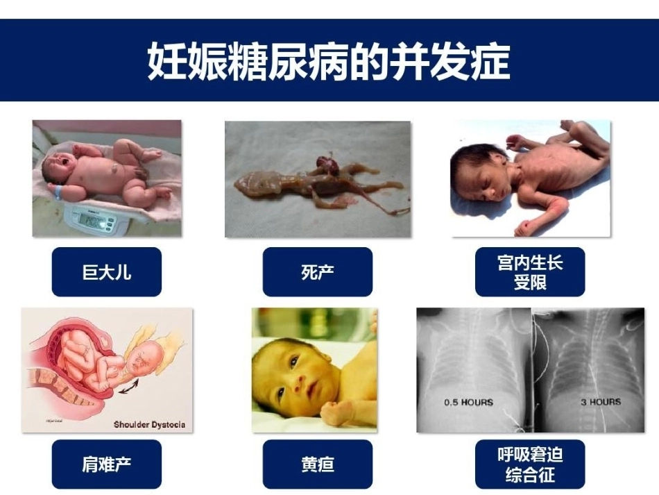 妊娠期糖尿病的胰岛素治疗_第9页