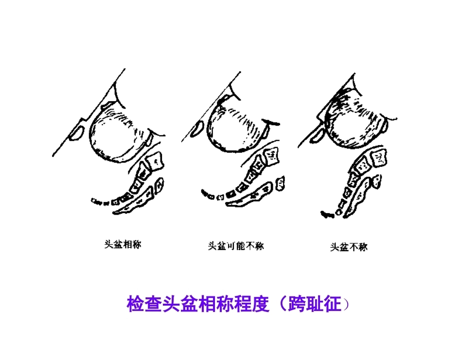 异常分娩及护理_第6页