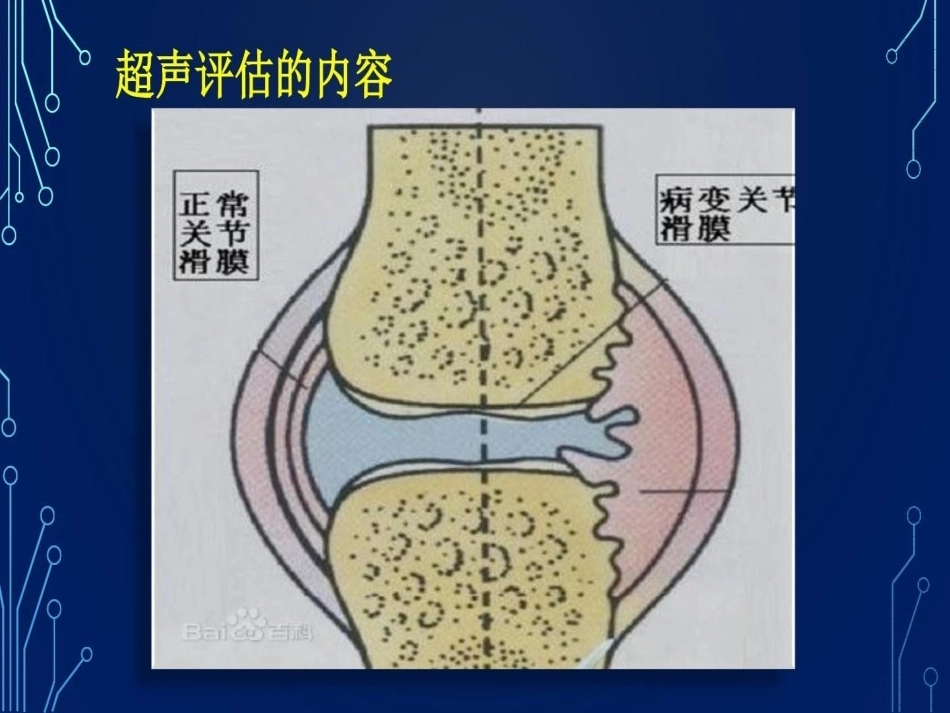 血友病关节超声检查的必要性_第13页