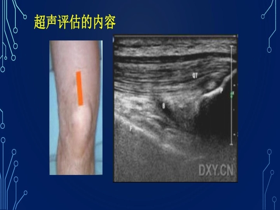 血友病关节超声检查的必要性_第14页