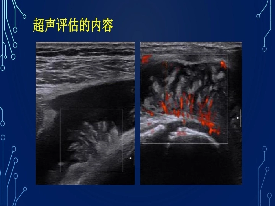 血友病关节超声检查的必要性_第15页