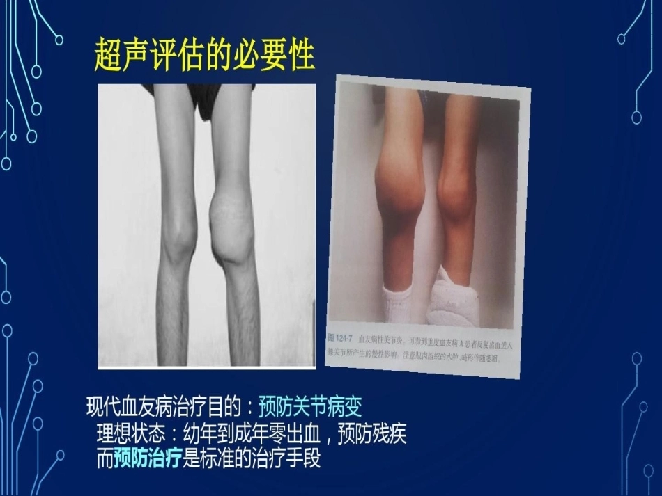 血友病关节超声检查的必要性_第5页