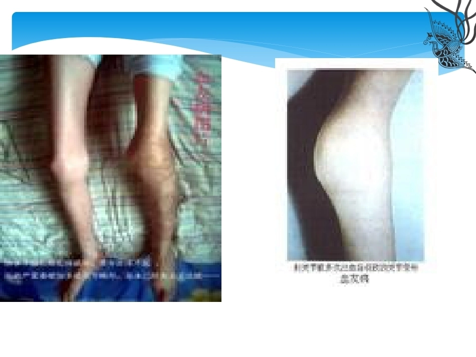 血友病介绍_第14页
