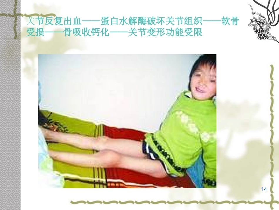 血友病 PPT课件_第14页