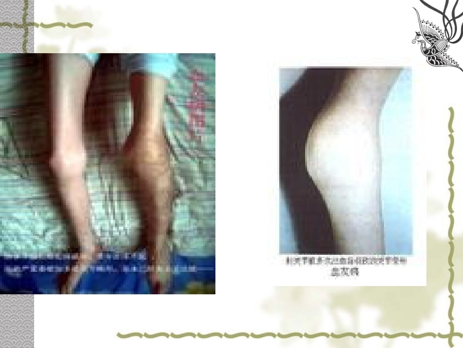 血友病 PPT课件_第15页
