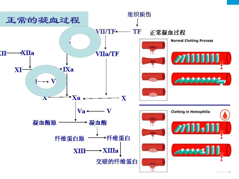 血友病医学课件_第5页