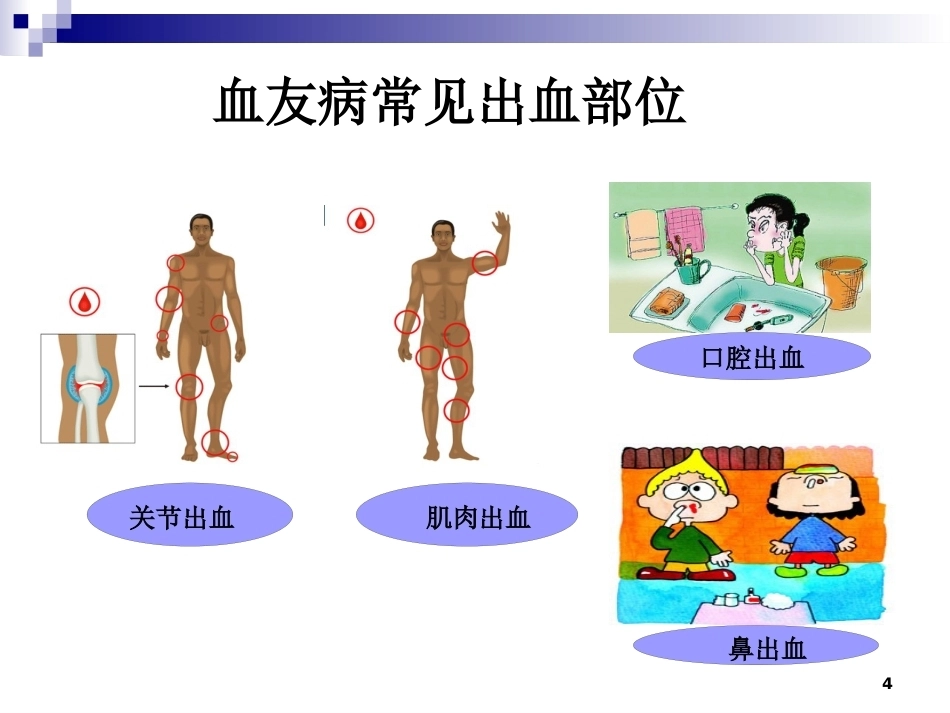 血友病诊治进展_第4页