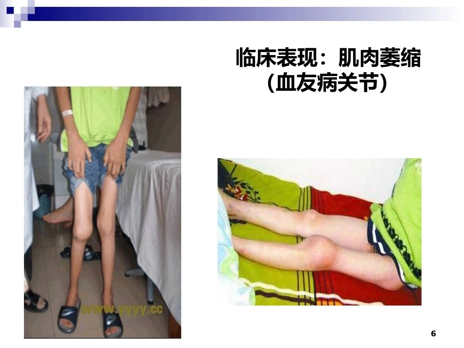 血友病诊治进展_第6页