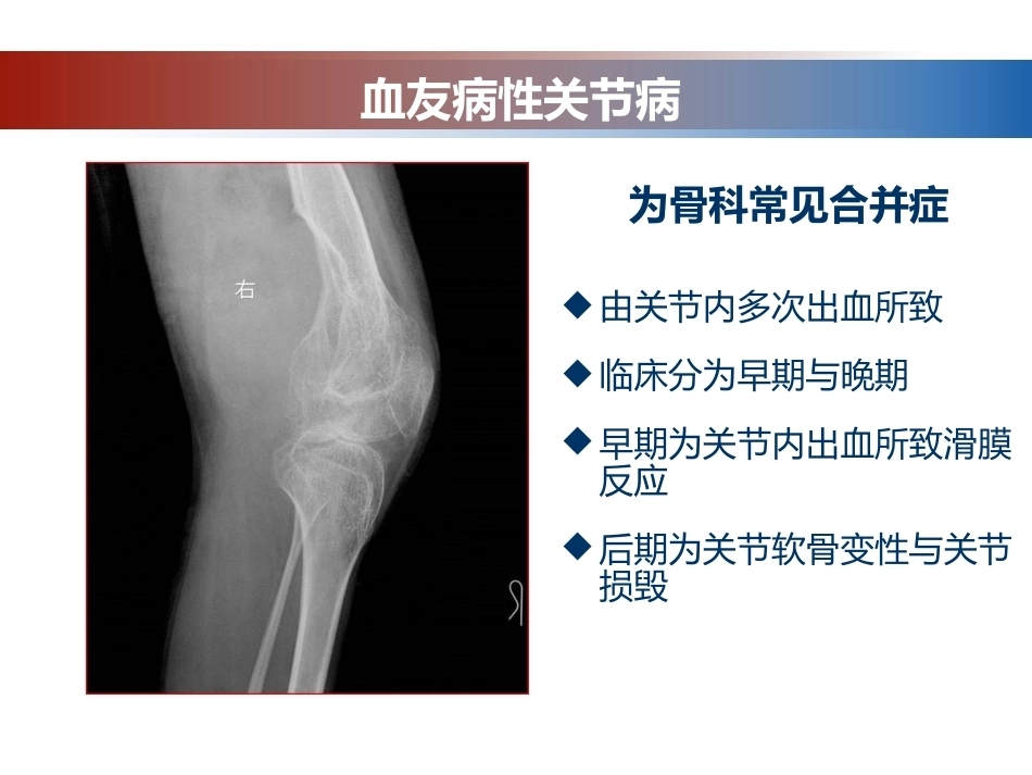 血友病性骨关节病的外科治疗_第11页