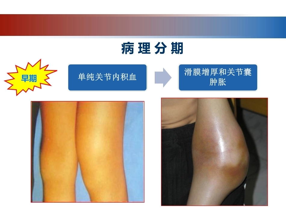 血友病性骨关节病的外科治疗_第12页