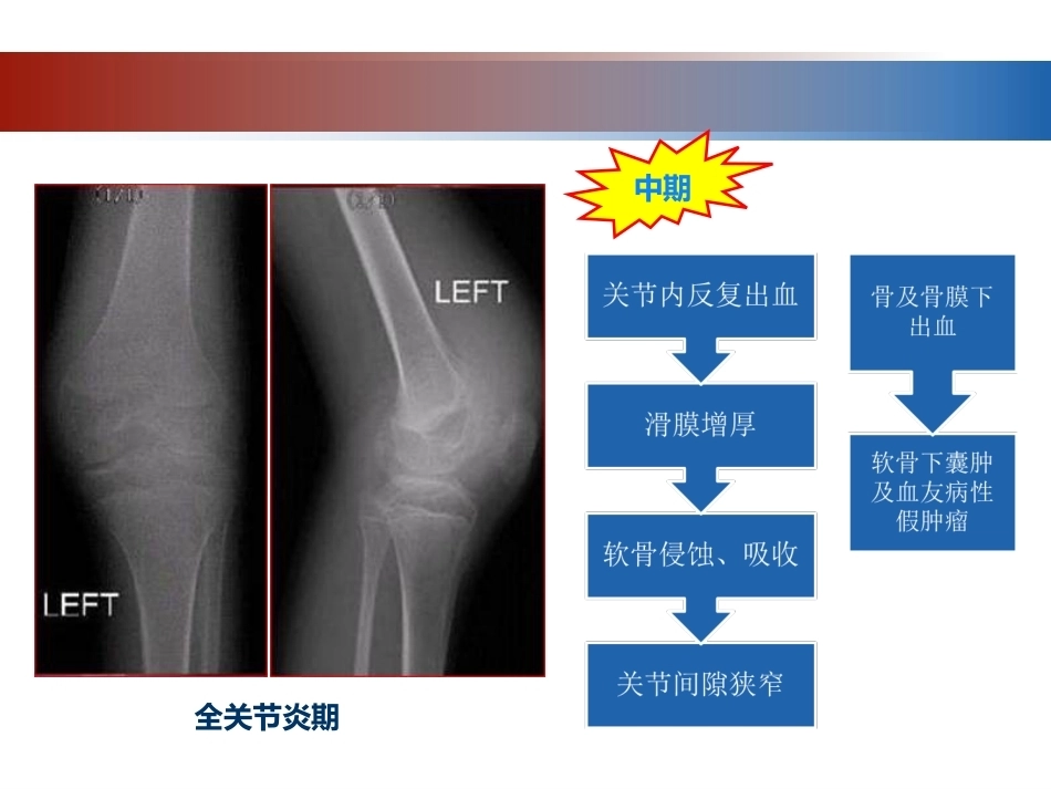 血友病性骨关节病的外科治疗_第13页