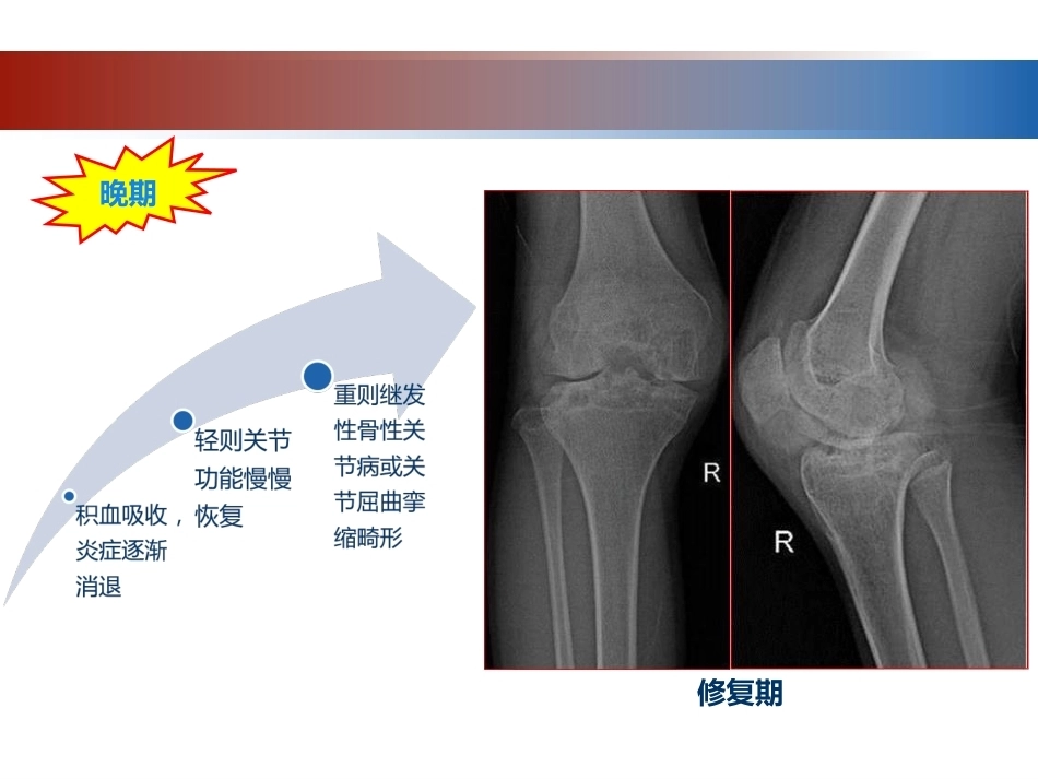 血友病性骨关节病的外科治疗_第14页