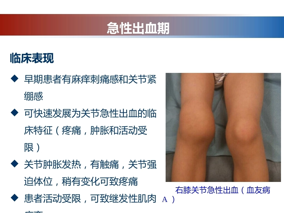 血友病性骨关节病的外科治疗_第15页
