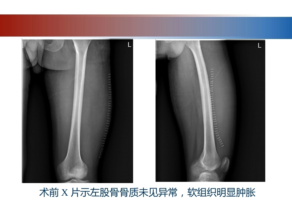 血友病性骨关节病的外科治疗_第4页
