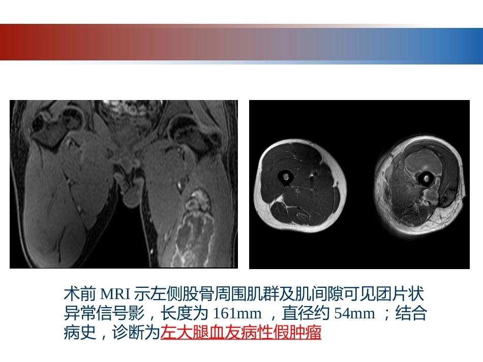 血友病性骨关节病的外科治疗_第5页