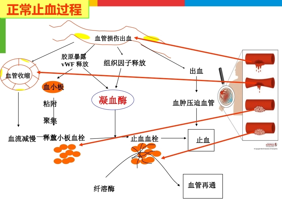 血友病综合治疗_第4页