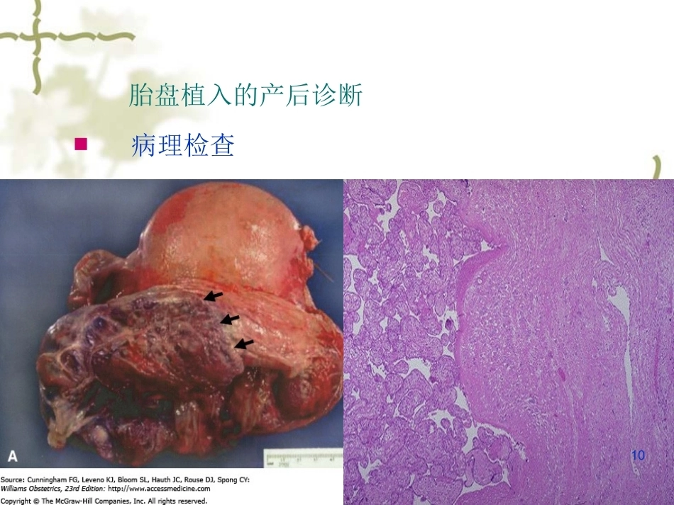 妊娠晚期出血产前出血_第10页