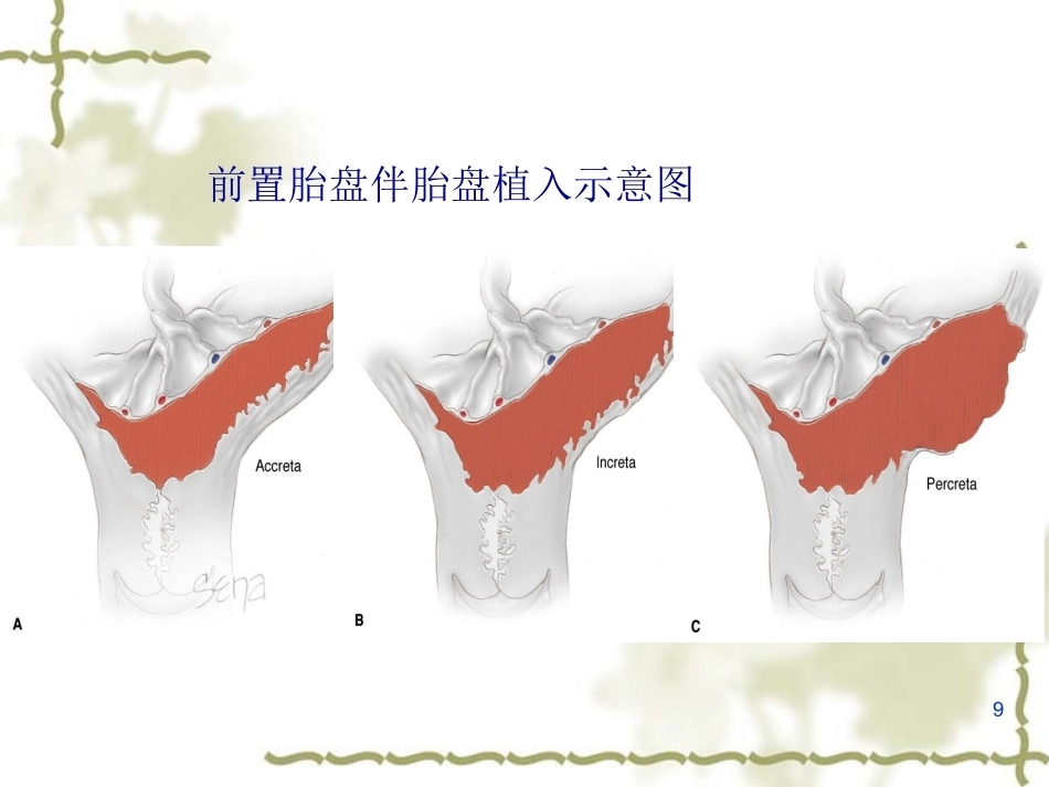 妊娠晚期出血产前出血_第9页