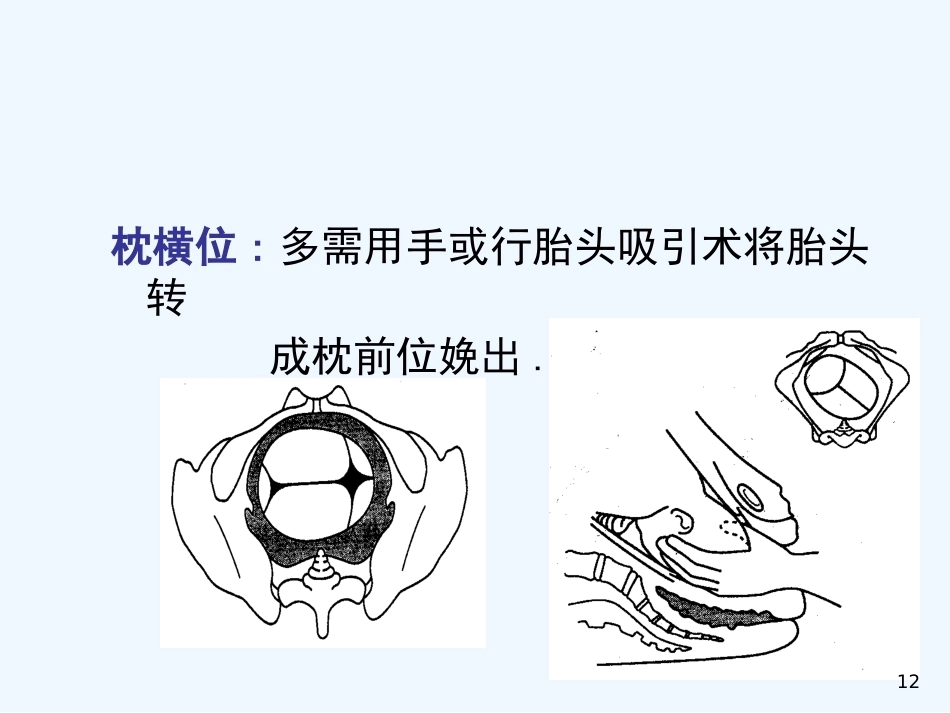 异常分娩胎位异常_第12页