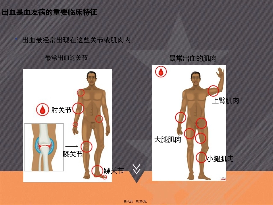 血友病的治疗和风险本讲课_第6页
