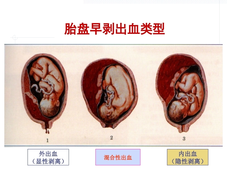妊娠中晚期出血_第11页