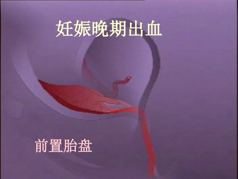 妊娠晚期出血性疾病_第1页