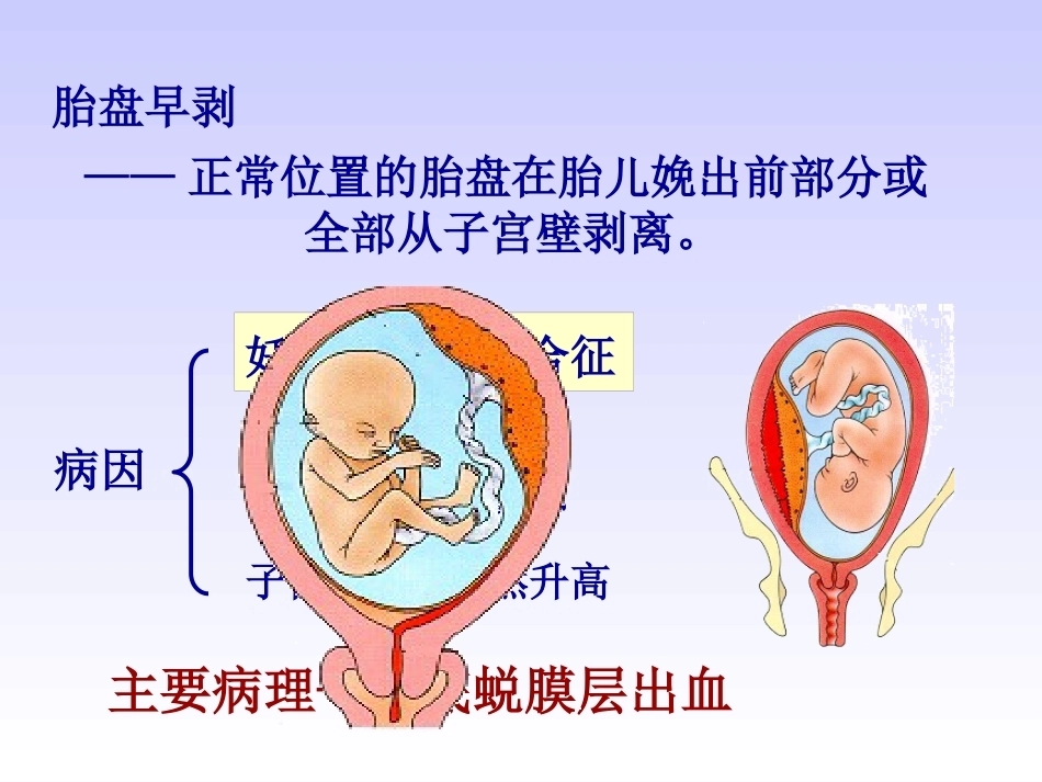 妊娠晚期出血性疾病_第12页