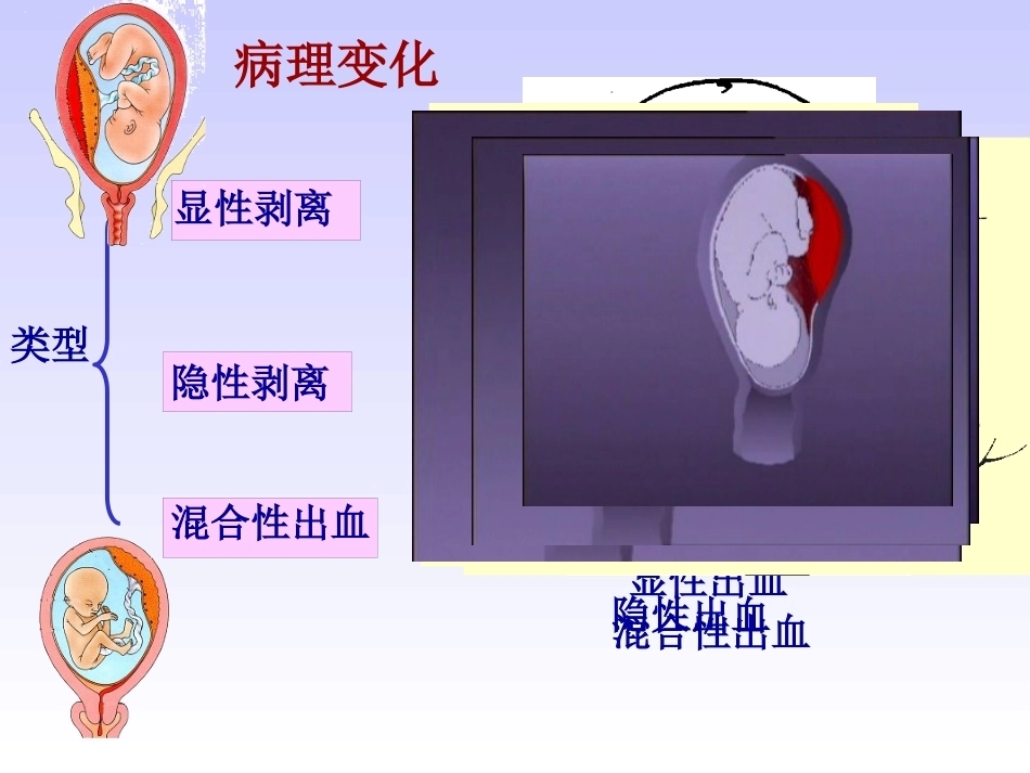 妊娠晚期出血性疾病_第13页