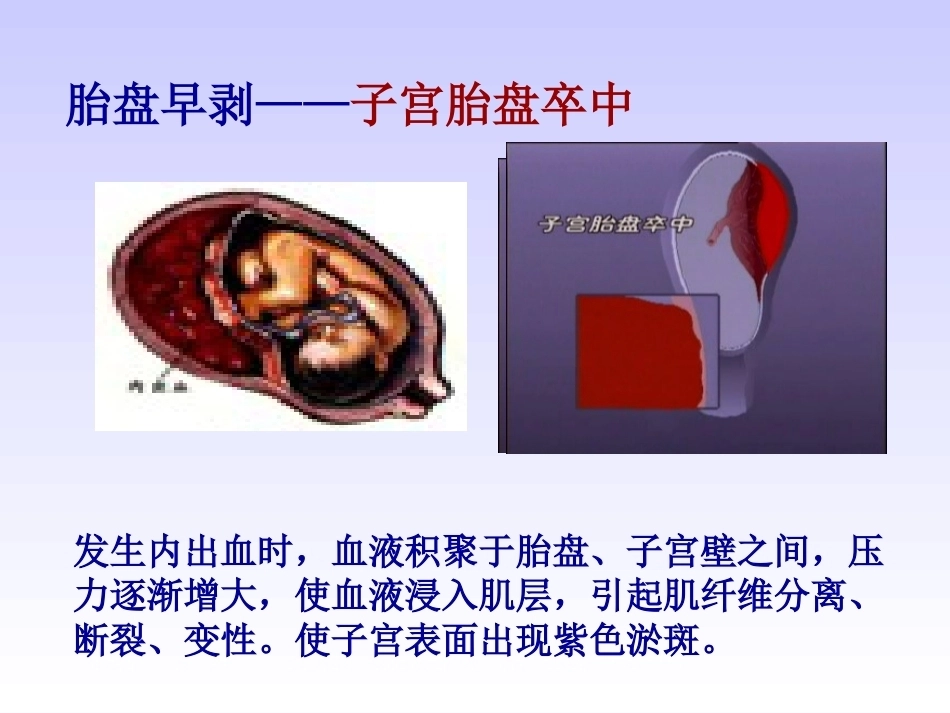 妊娠晚期出血性疾病_第14页