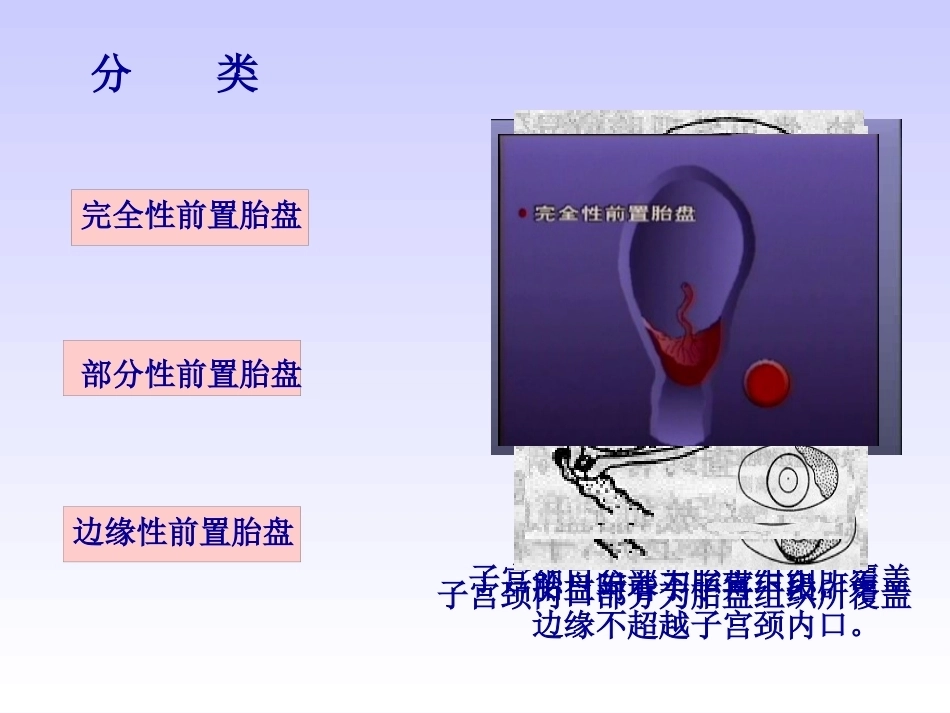 妊娠晚期出血性疾病_第3页