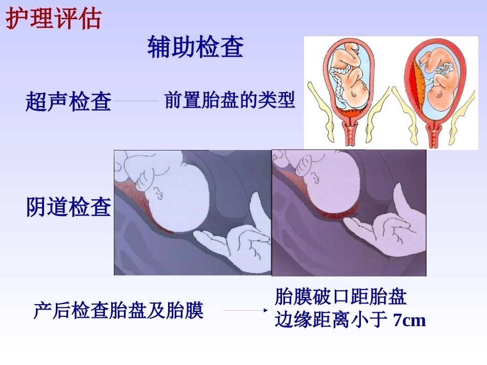 妊娠晚期出血性疾病_第7页