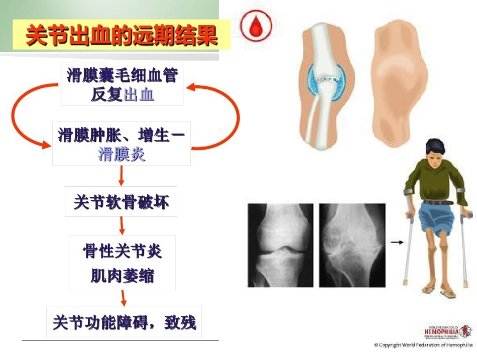 血友病 患者科普3_第15页