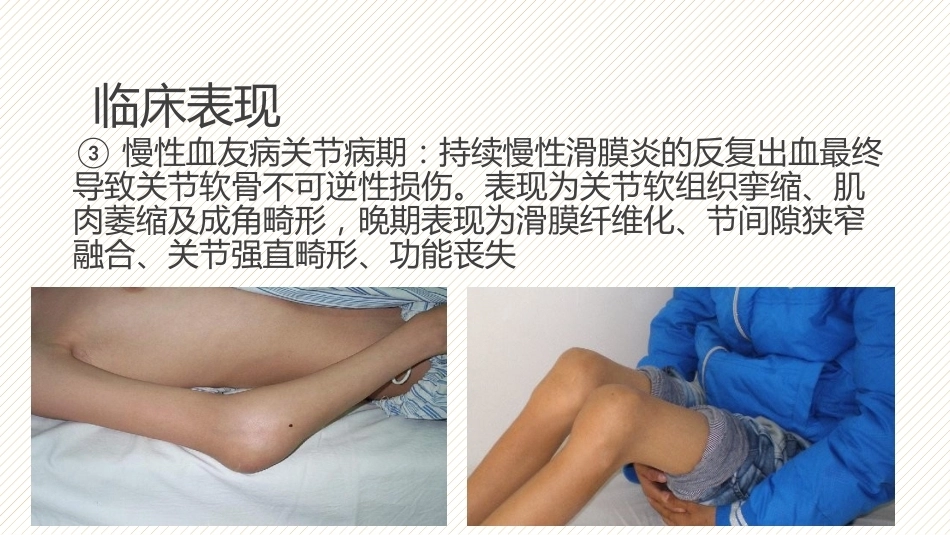 血友病8_第12页