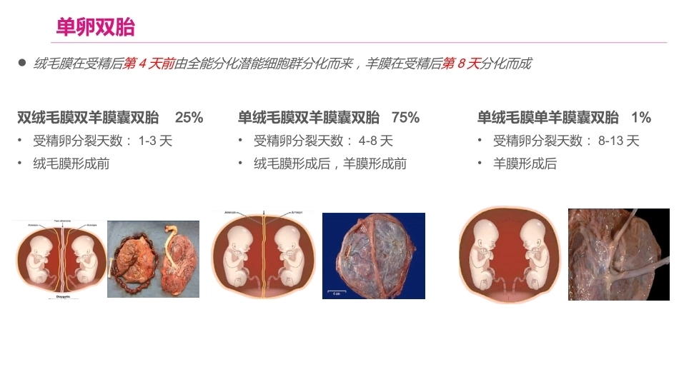 双胎妊娠的产前超声诊断_第10页