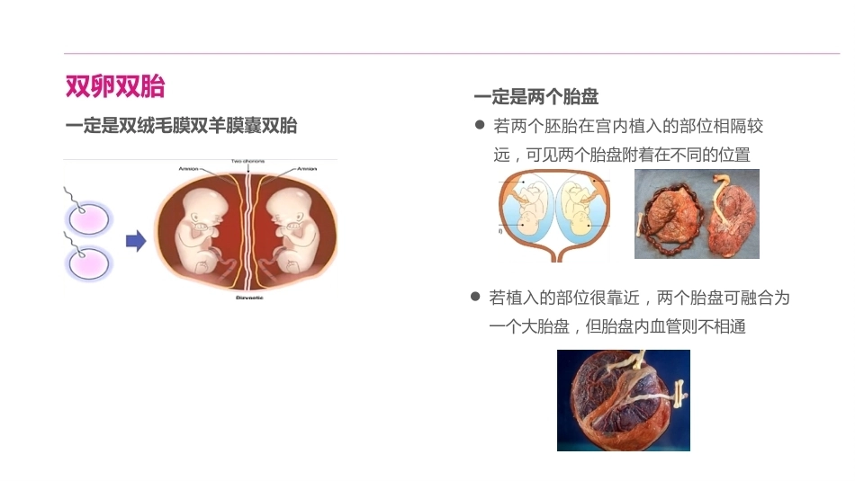 双胎妊娠的产前超声诊断_第8页