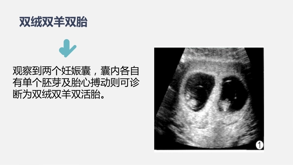 双胎妊娠超声诊断思路_第10页