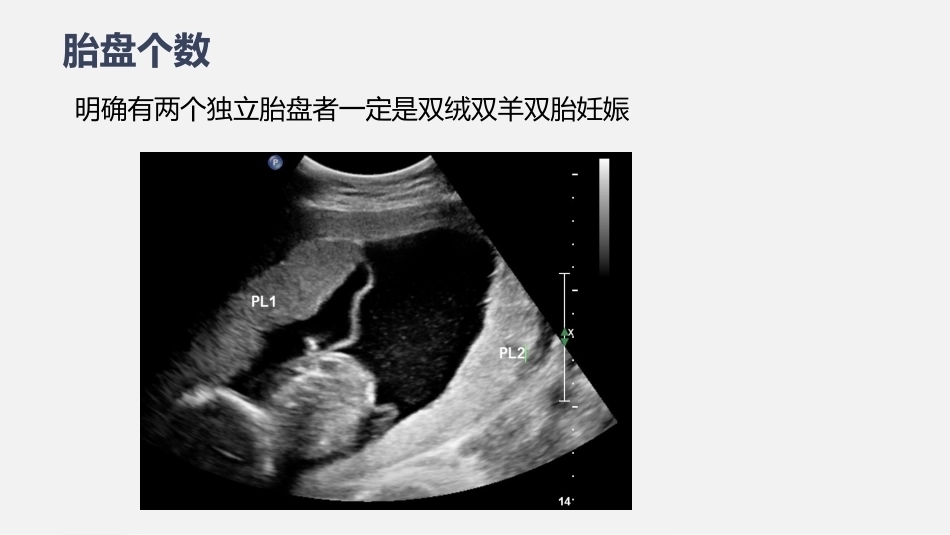 双胎妊娠超声诊断思路_第14页
