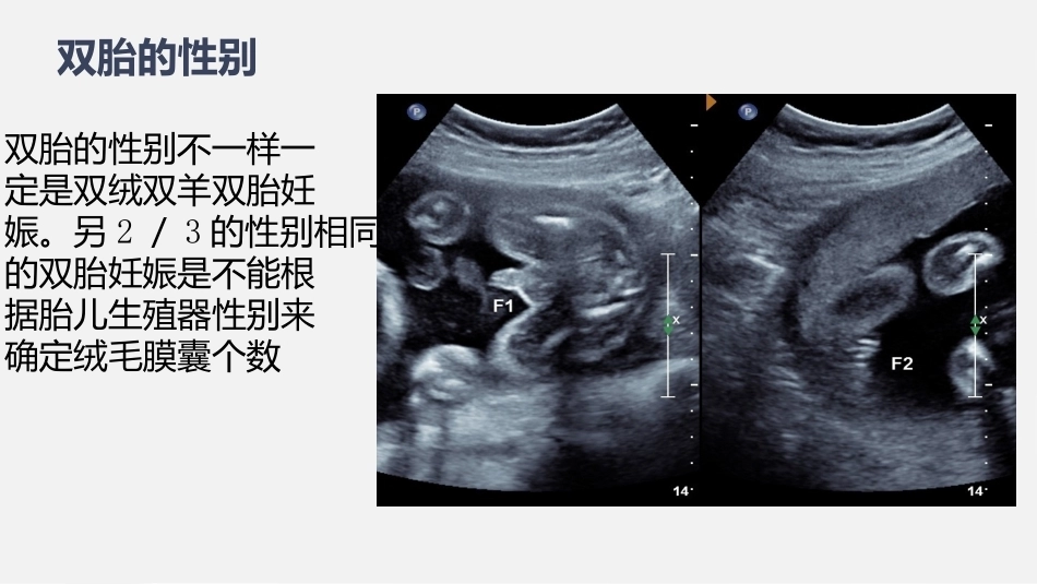 双胎妊娠超声诊断思路_第15页