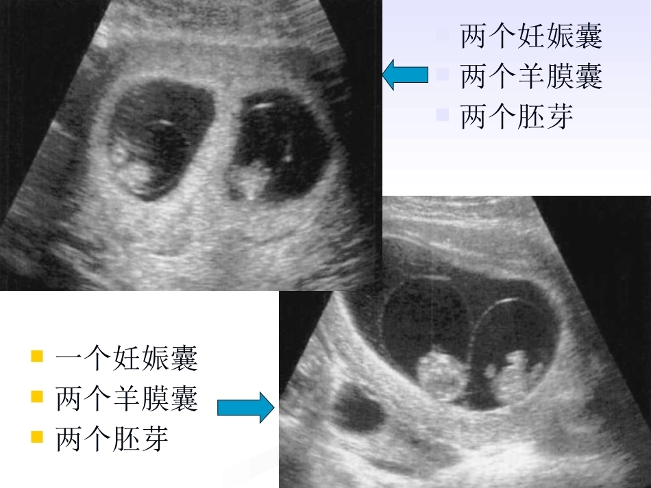 双胎妊娠的绒毛膜性超声诊断_第11页