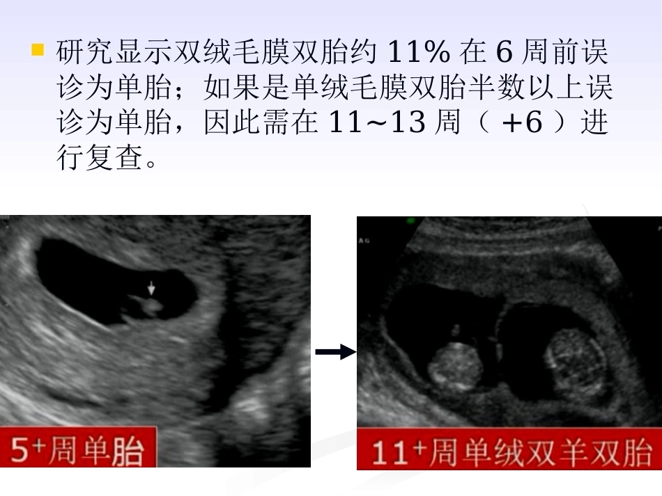 双胎妊娠的绒毛膜性超声诊断_第12页