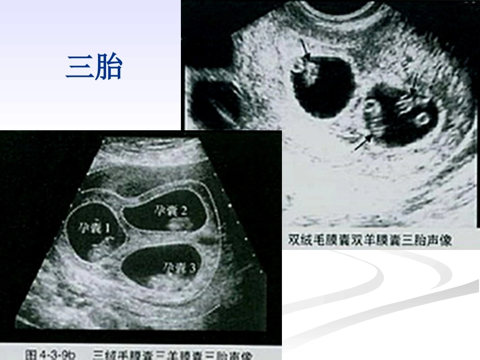 双胎妊娠的绒毛膜性超声诊断_第13页