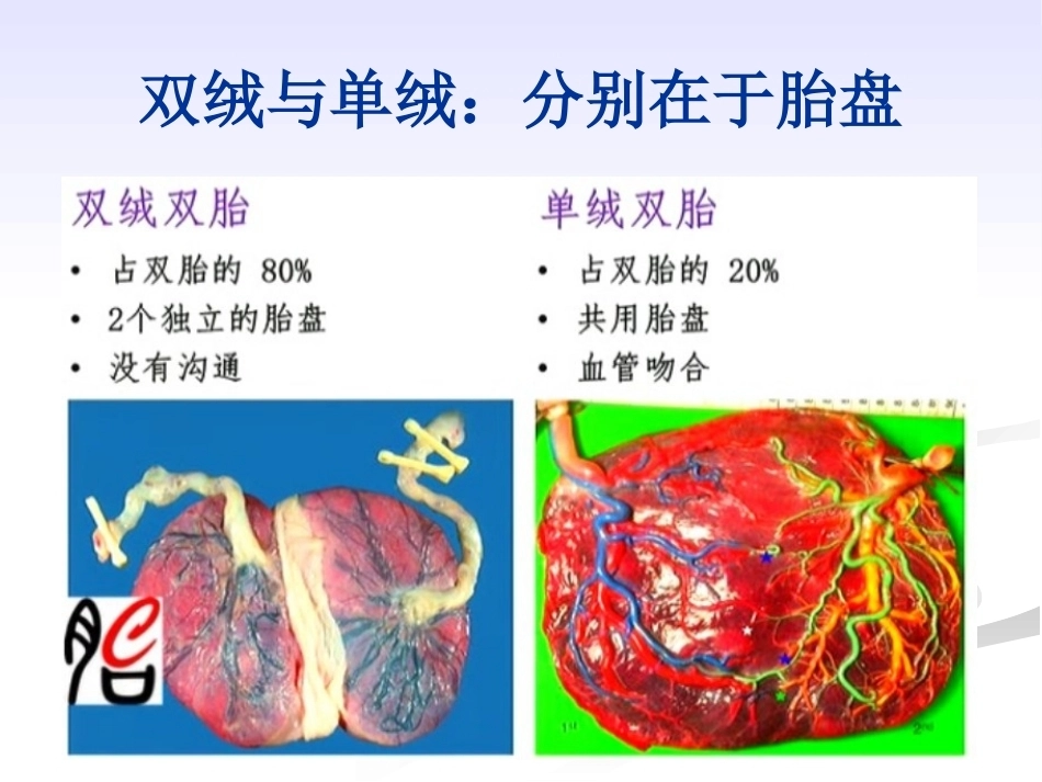 双胎妊娠的绒毛膜性超声诊断_第5页