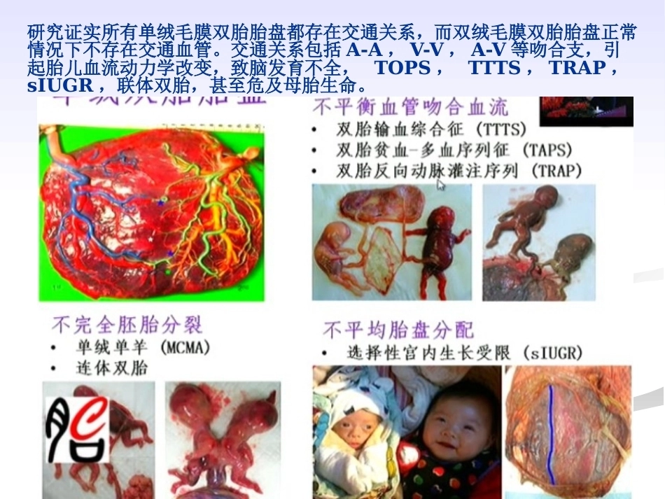 双胎妊娠的绒毛膜性超声诊断_第6页