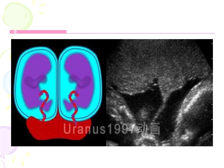 双胎妊娠最新版本_第13页