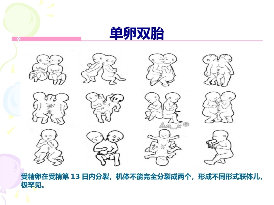 双胎妊娠最新版本_第6页