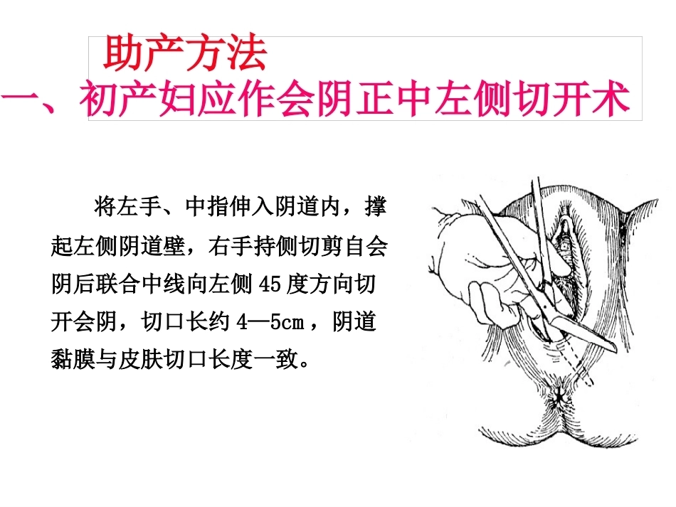 臀位分娩_第15页